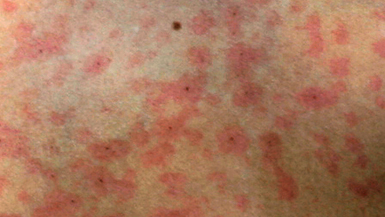 adult Measles threat health to