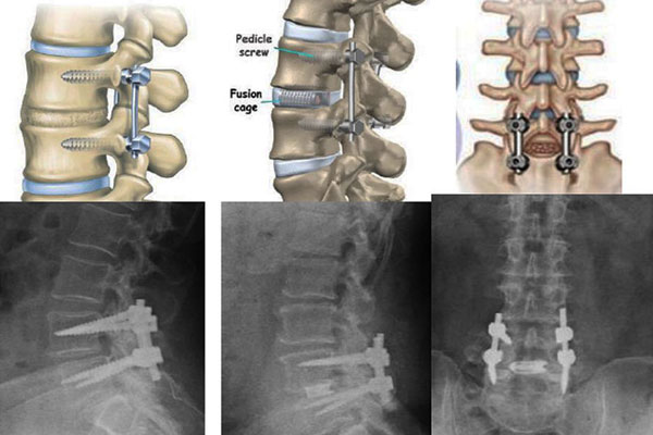 STARS lumbar spine fusion surgery image