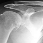 Study explores best approach to surgery for painful shoulder osteoarthritis