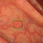 Using artificial intelligence for polyp detection in colonoscopy