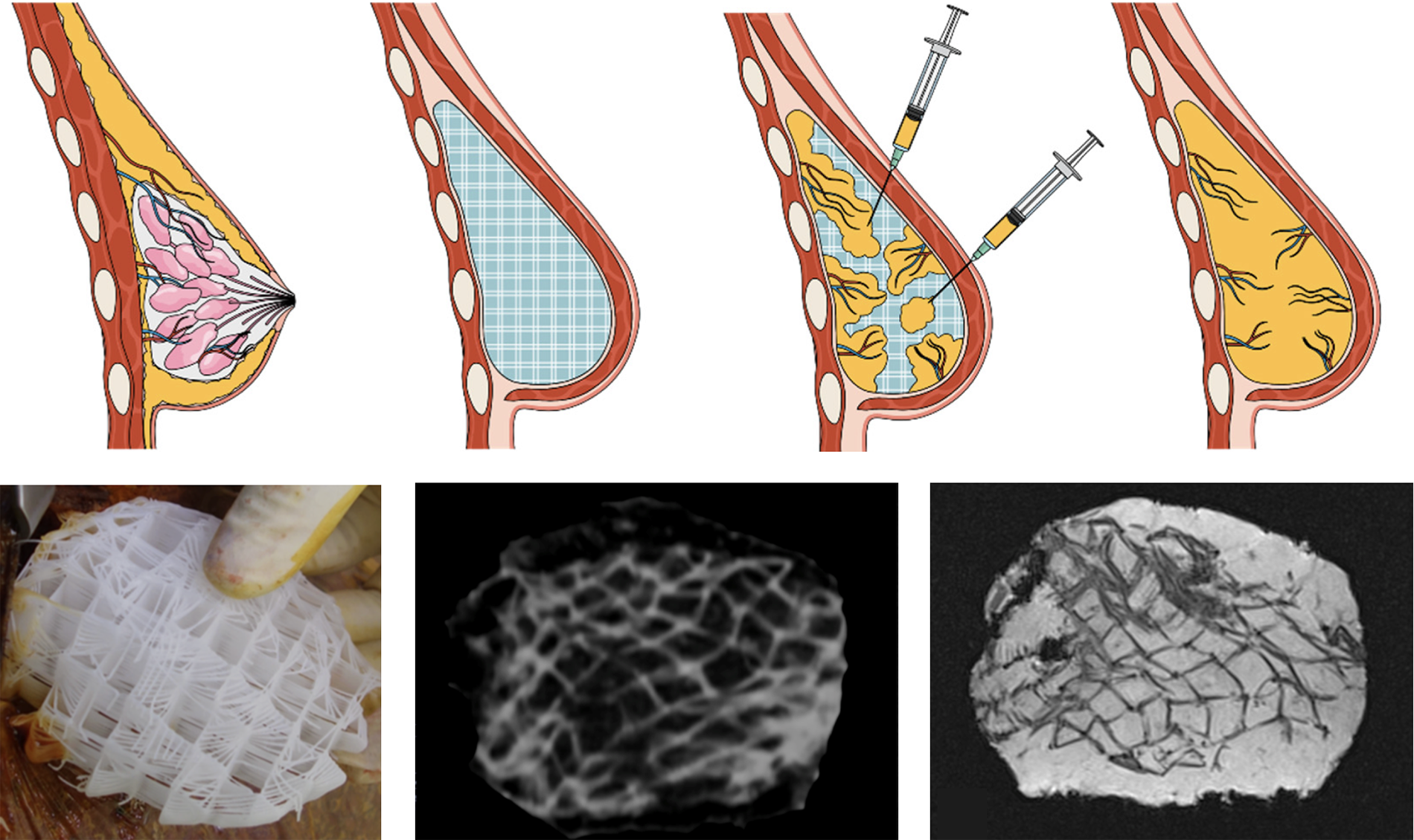 breast-scaffold-figure Illustration and photos composite image show breast scaffold