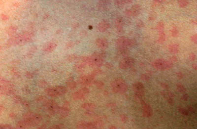Measles alert