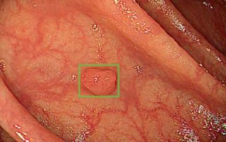 AI identifies areas of interest in a colonoscopy