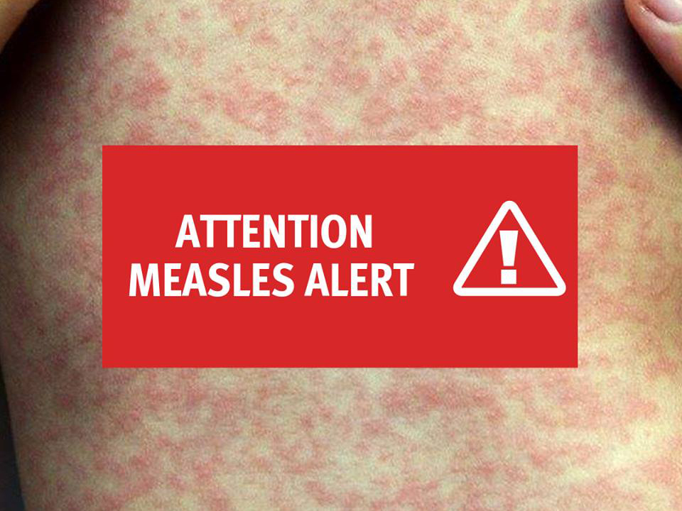 Measles alert for Brisbane Metro North Health